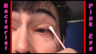 Severe Bacterial Pink Eye Conjunctivitis treatment part 3 [upl. by Bennie]