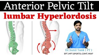 How To Fix Anterior Pelvic Tilt in 15 Mins  Yatinder Singh [upl. by Etnud]