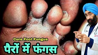 Fungal Feet Infection ka pakka elaaj  Athletes Foot Cure  Tenia Pedis  DrEducation Hindi [upl. by Merriman445]