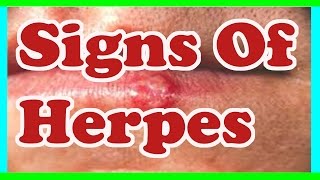 Signs Of herpes  Symptoms Of herpes [upl. by Asum]