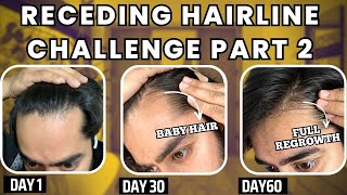 30 days HAIRLINE REGROWTH challenge PART 2  सिर्फ 1 महीने मैं RECEDING HAIRLINE REGROW करो [upl. by Croydon583]