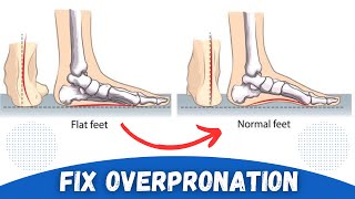 How to Correct Overpronation Fallen Arches [upl. by Yann]