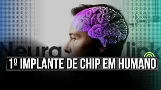 ELON MUSK SURPREENDE Neuralink Realiza o 1º IMPLANTE DE CHIP EM CÉREBRO HUMANO [upl. by Nitnerb199]