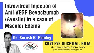 Intravitreal Injection of AntiVEGF Bevacizumab Avastin in a case of Macular Edemampg [upl. by Tobe]