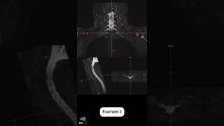 MRI  Brachiale Plexus  Angulation [upl. by Ttennej]