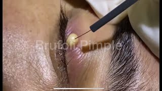 Removal of a large blackhead on the eye 😱  Entfernung eines großen Mitessers am Auge [upl. by Otilesoj409]