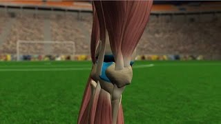 Lesiones de rodilla [upl. by Seldun]