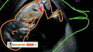 Right side movement Baby Boy Baby boy on ultrasound Radiology vibes [upl. by Secor]