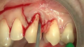 9 Multiple bilaminar technique with single vertical releasing incision in the upper jaw [upl. by Gavette]