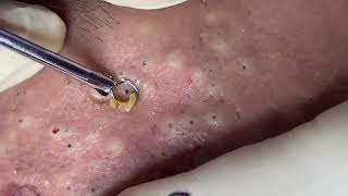 blackheads New this week 2023 [upl. by Carey]