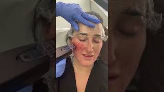 MORPHEUS8 for skin tightening [upl. by Lejeune]