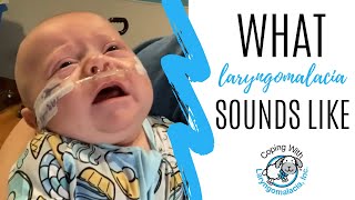 What Laryngomalacia Sounds Like  noisy breathing  newborn congestion [upl. by Patrice318]