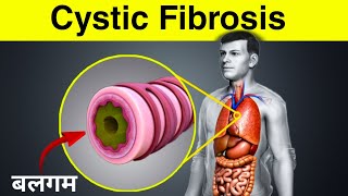 फेफड़ों में बलगम जमा देने वाली बीमारी  cystic fibrosis [upl. by Aicitan]