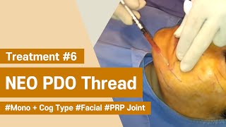 NeoGenesis Thread Series PDO Cog  Mono Type Facial Joint Procedure with PRP [upl. by Breeze]