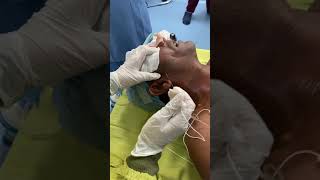 Mandibular Nerve Block with PNS [upl. by Aydne]