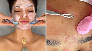 ACNE NO Talking SPAASMR Facial Pimple Popping [upl. by Annat]