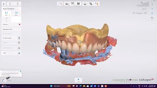 CUDCPLD Intraoral Scan [upl. by Miahc]