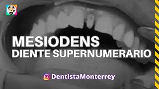 MESIODENS Diente SUPERNUMERARIO👅 Corona Dental mesiodens dentaltip [upl. by Engle263]