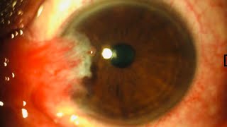 Pterygium Corrections for Recurrent Pinguecula 7 PterygiumComplications NYC to GulaniVision [upl. by Eugenie]