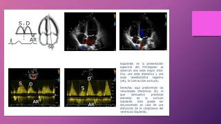 Ecocardiograma modo Doppler [upl. by Yborian]