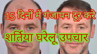 गंजापन कैसे दूर करें quotganja pan kaise dur karequot by gd health amp tips [upl. by Odiug]