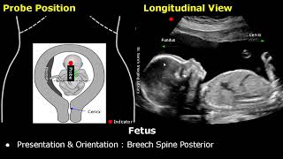 Obstetric Ultrasound Probe Positioning  Pregnant Uterus amp Fetus Transducer Placement USG Scan [upl. by Riggall]