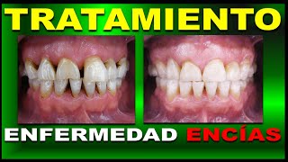 FASE I Y II DEL TRATAMIENTO DE LA ENFERMEDAD PERIODONTAL [upl. by Arua585]