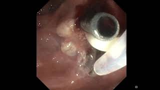 Ampullectomy of a papillary adenoma [upl. by Walston203]