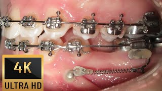 👍MISSING mandibular PREMOLAR in 4K HOW BRACES WORK Miniscrew TAD [upl. by Stryker]