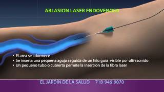 Animation of Ablación Laser Endovenosa [upl. by Pelletier]