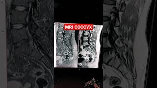 MRI of Coccyx  Post Traumatic Fracture mri shorts mriradiographer MRI L S Spine with Coccyx [upl. by Eniamat]