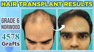 💥Best Hair Transplant in India  Hair Transplant Results After 9 Months  Patient Review [upl. by Antonetta369]