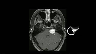 Schwannoma vestibular [upl. by Harday]