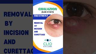 Chalazion Treatment Incision and Curettage  CLIO Eye Care [upl. by Yssis147]