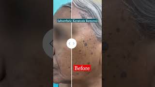 Seborrheic Keratosis PrePost getglowingskin bestskintreatment skinspecialistinbaroda experts [upl. by Elokyn442]