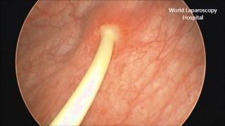 Removal of Double J stent by Cystoscopy [upl. by Aihtenyc]