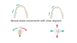 Mesialdistal movements with aligners My lecture from 2020  Part 3 [upl. by Alioz206]