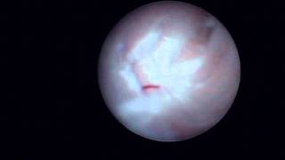 Arthroscopy of the Jaw Temporomandibular Joint TMJ  Part 3 [upl. by Valaree]