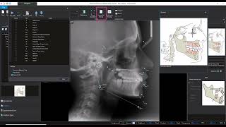 Romexis® 6 2D Tracing  På vilka sätt kan du göra din Tracing [upl. by Paehpos683]