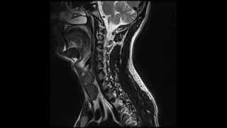 MRI  Incomplete T7 Spinal Cord Injury [upl. by Isaac317]