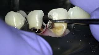 injectable composite restorations [upl. by Cristina765]