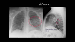 What is a Pneumothorax EXPLAINED [upl. by Anelac]