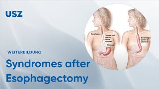 Functional syndromes after Esophagectomy – Please participate in our 3minute survey below [upl. by Lal718]