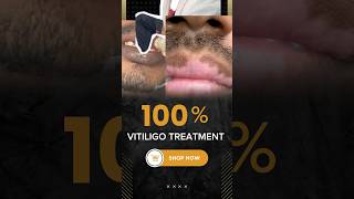 VITILIGO CURES  VITILIGO PERMANENT CAMOUFLAGE COLOURING VITILIGO PIGMENTOZ PROCESS vitiligoindia [upl. by Nibaj]