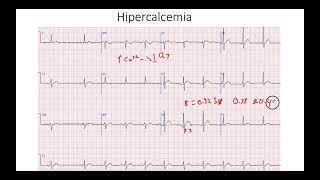 Hipocalcemia e hipercalcemia [upl. by Yngad]