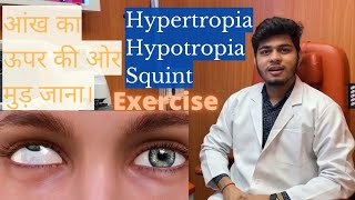 Hypertropia treatment exercises Hypertropia and hypotropia  Squint eye exercises eye caretaker [upl. by Boru964]