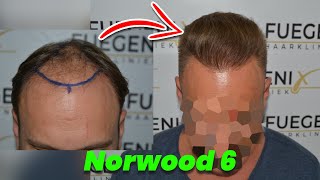 Norwood 6  Hair Transplant  FueGenix  Dr Munib Ahmad [upl. by Aziaf]