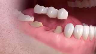 Straumann  Conventional 3unit bridge treatment [upl. by Lorien]