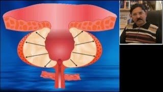 Learining 3D anatomy of prostate prior to TURP [upl. by Zetrauq]