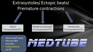 ECGs abnormal rhythms Extrasystoles [upl. by Htenywg997]